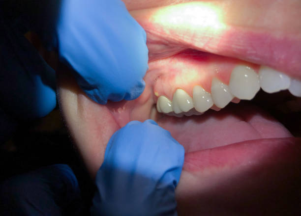 Best Emergency Treatment for Toothache in Fredericksburg, TX