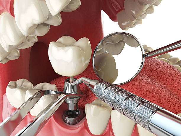 Best Emergency Tooth Extraction in Fredericksburg, TX